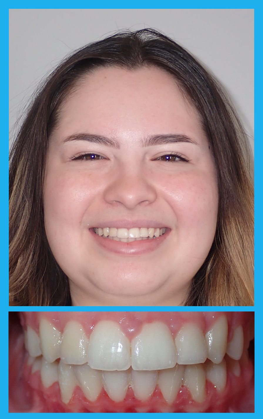 Before And Afters Mvp Orthodontics